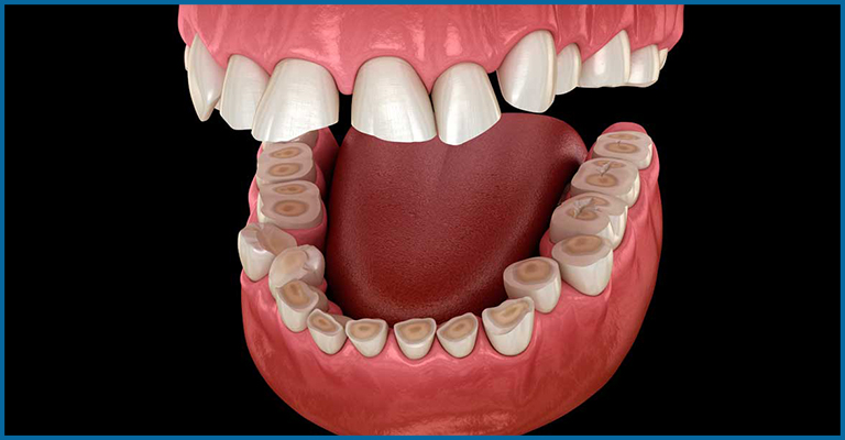 Flattened tooth surface