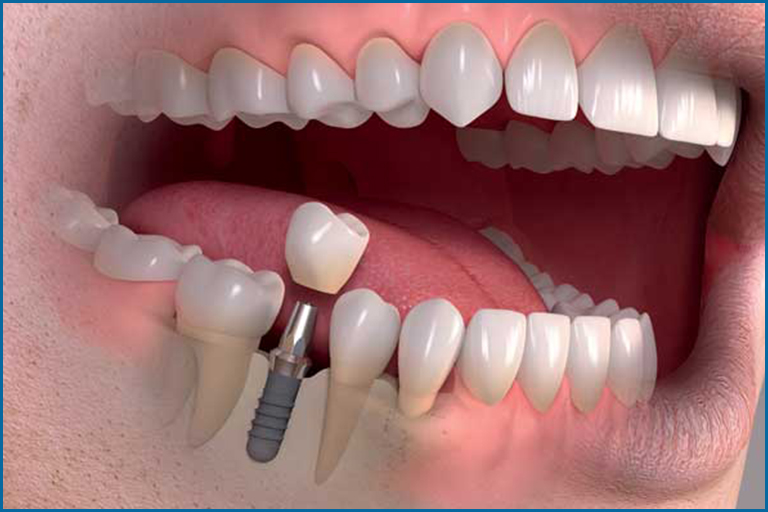 dental implants fixing
