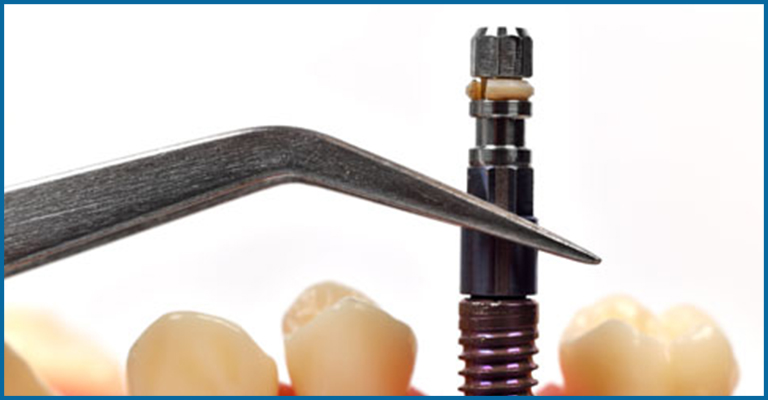 implant fixing