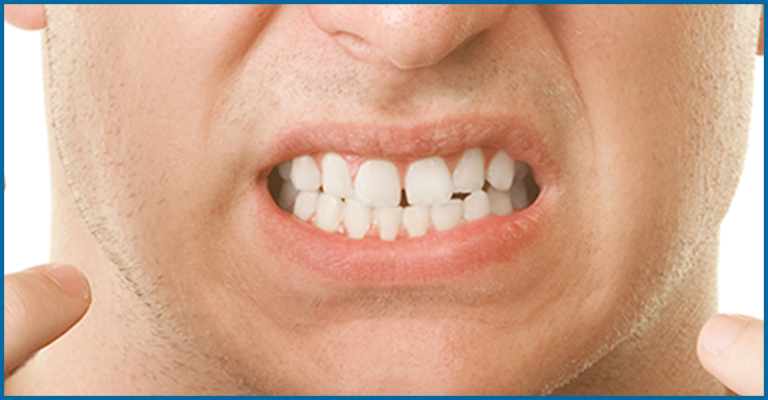 bruxism