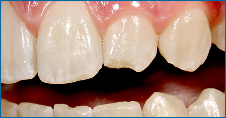 How Nail Biting Affects Your Health | Onlymyhealth