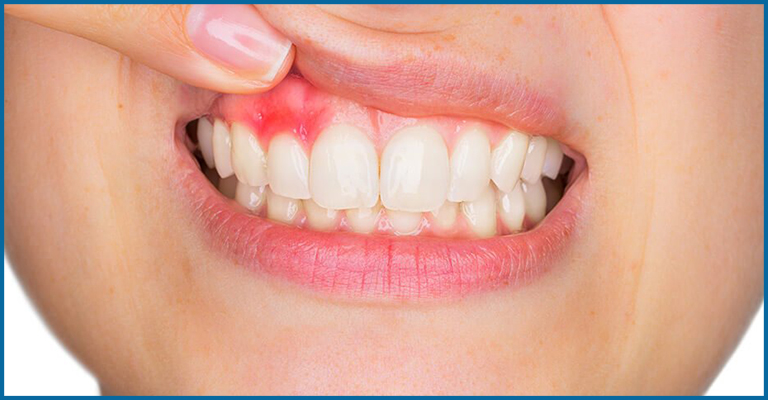 gum inflammation
