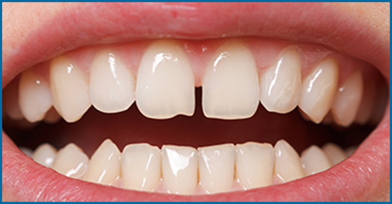 What to Know About Calcium and Your Teeth