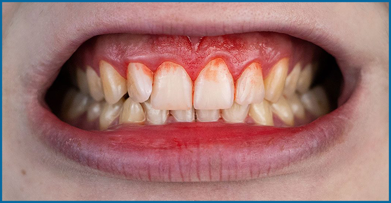 bleeding of gums