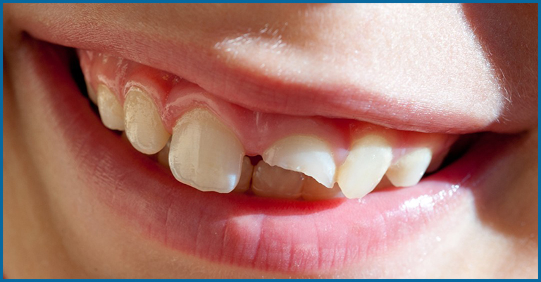 chipped off teeth