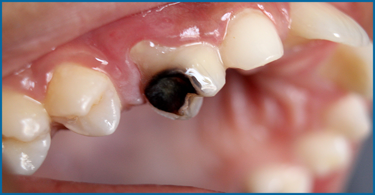 decayed milk teeth