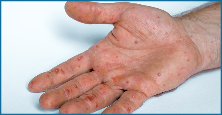 monkeypox rash