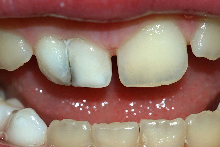 Condensing Osteitis: Symptoms, Diagnosis and Management
