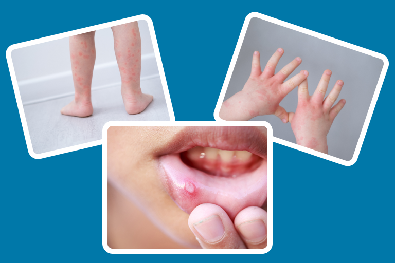 Hand Foot And Mouth Disease