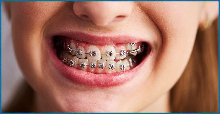 braces