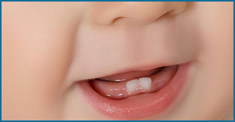 baby with natal teeth
