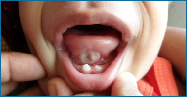 diagnosis of natal teeth