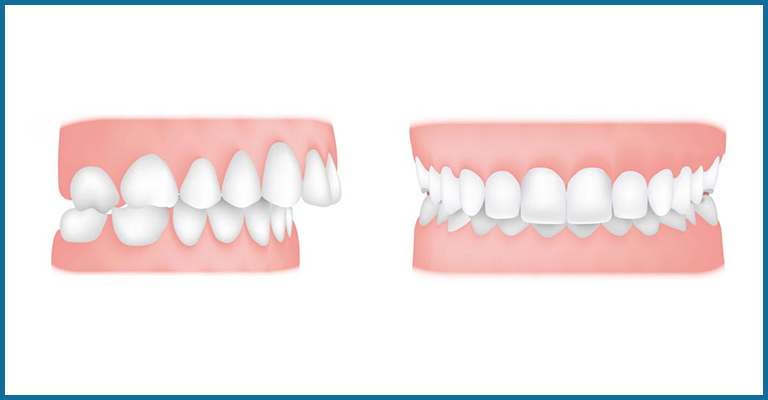 overjet and an overbite