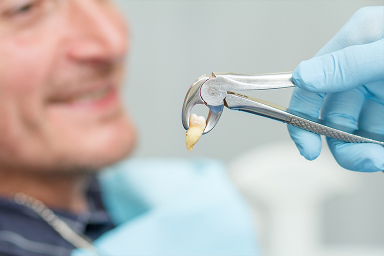 tooth extraction