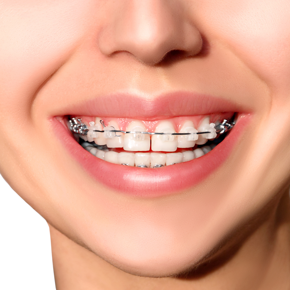 What are the Natural Treatments for Bleeding Gums