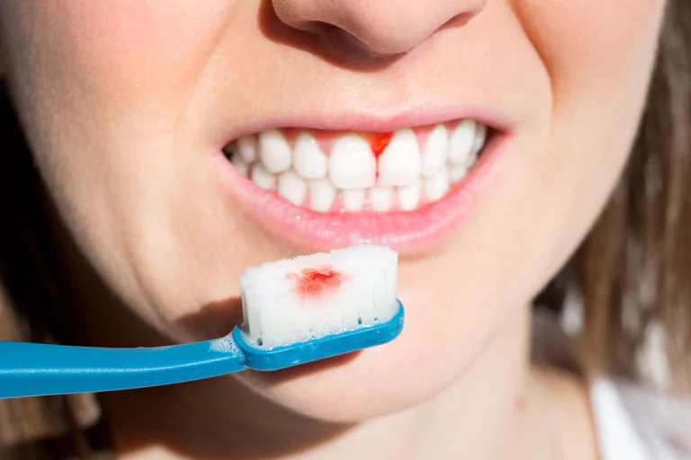 18 Reasons for Gum Bleeding While Brushing