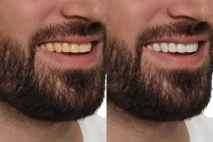 Composite Veneers