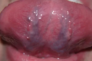 Is Caviar Tongue Dangerous?