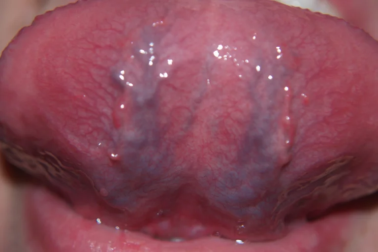 Is Caviar Tongue Dangerous?