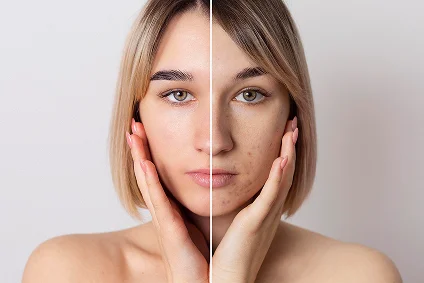 Microneedling For Acne Scars