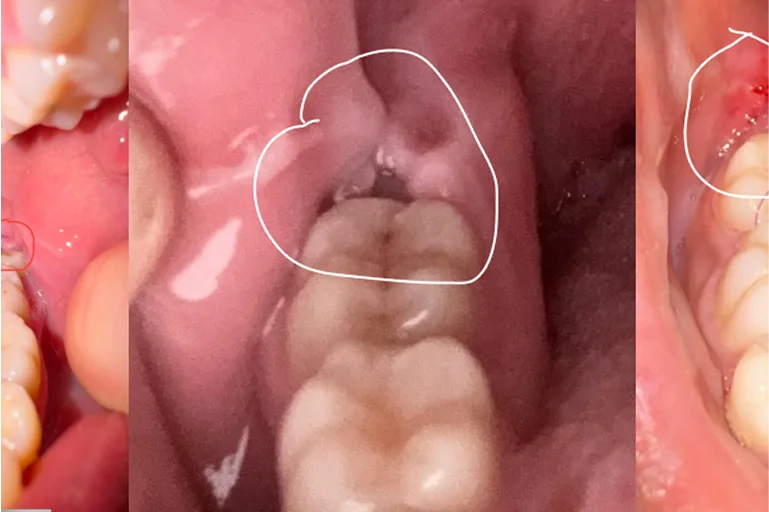 What Is Pericoronitis and How To Cure Them?