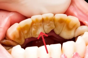 Tartar on Teeth