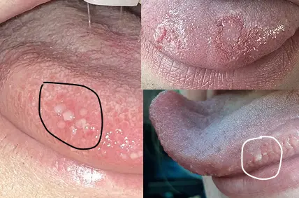 Lie Bumps (Transient Lingual Papillitis)