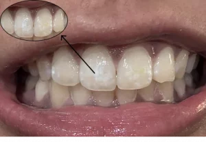 White Spots On Teeth