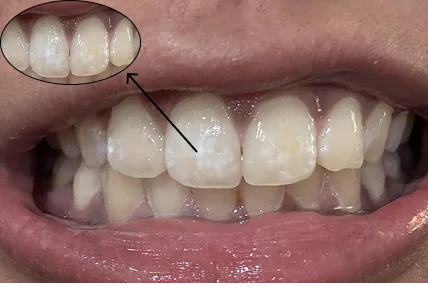 White Spots On Teeth