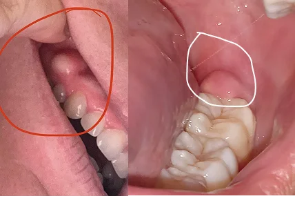 pictures of gum boils