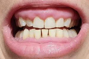Gingival Hyperplasia Photos