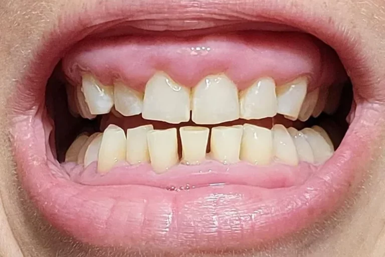 Gingival Hyperplasia Photos
