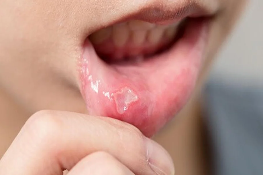 Mouth Ulcer Treatment in Dubai: Treatments and Remedies