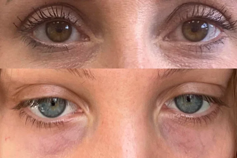 Thin Skin Under Eyes: Symptoms, Causes and Treatments