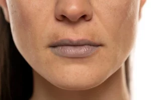 Dark Lips Removal Options