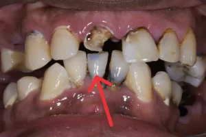 Rotten Teeth