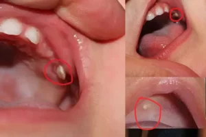 Epstein Pearls in Newborns