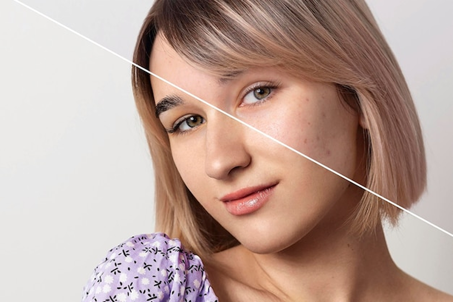 Skin Resurfacing for Acne Scars, Wrinkles & Pigmentation in Dubai