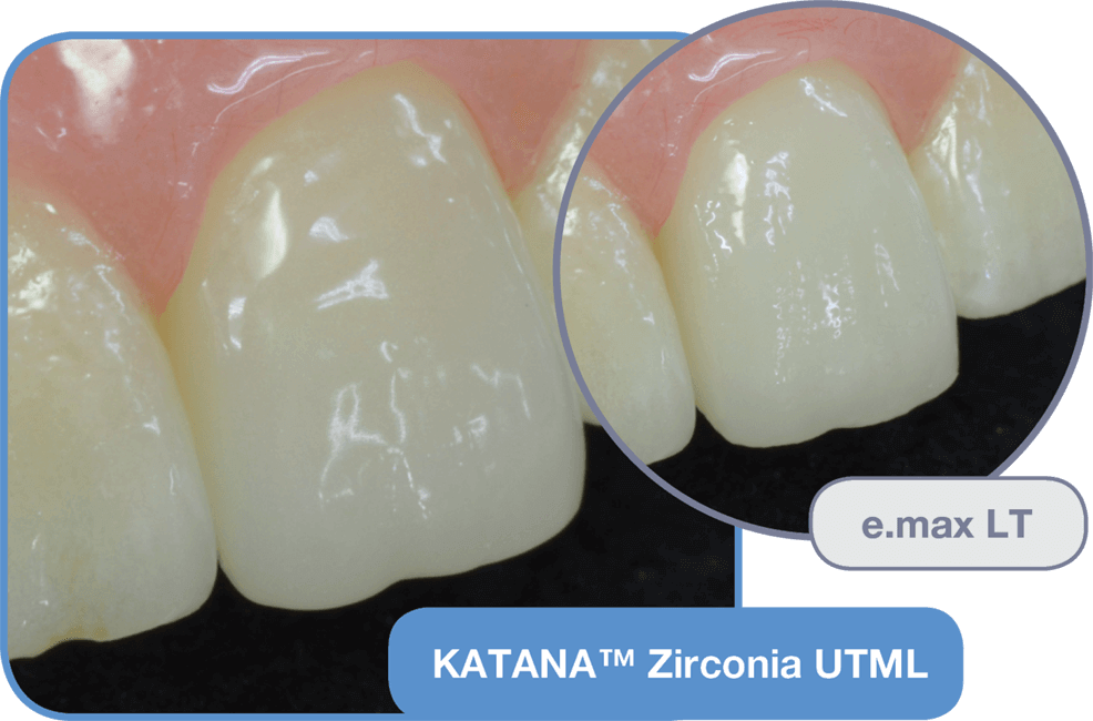 Zirconia Crowns Zirconia Crowns