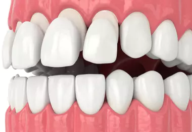 Dental Veneers in Dubai | Veneers in Dubai - Oris Dental Center