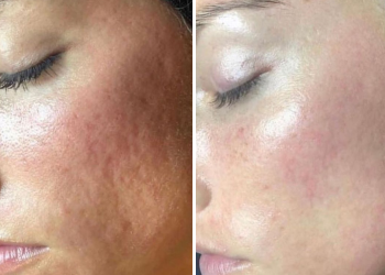 Acne scar treatment Acne scar treatment