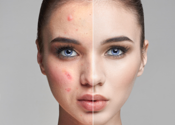 Pigmentation Treatment Pigmentation Treatment