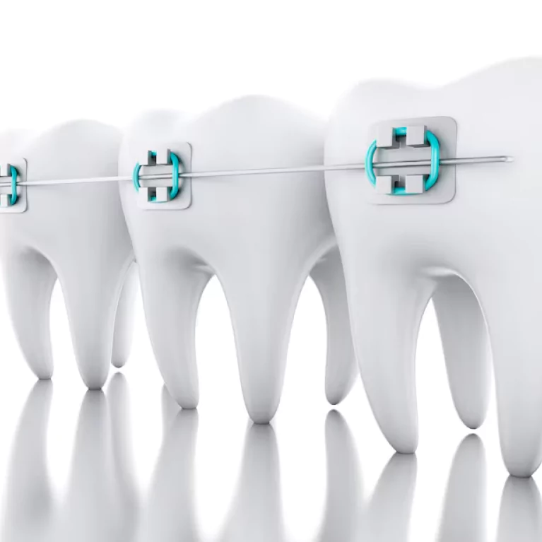Dental Braces Treatments: Postoperative Care