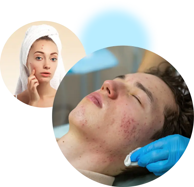 Acne Scar Treatment