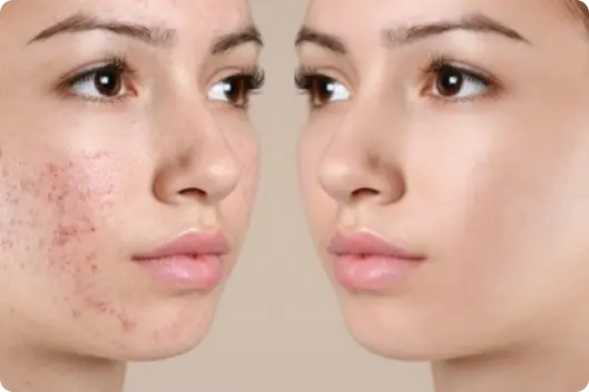 acne-scar