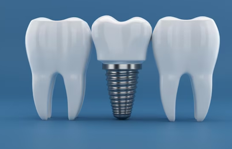 Dental implant