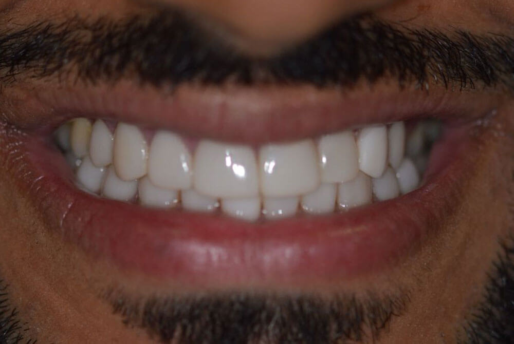 Zirconia Crowns Zirconia Crowns