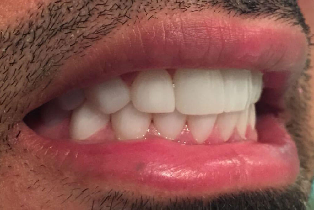 Zirconia Crowns Zirconia Crowns