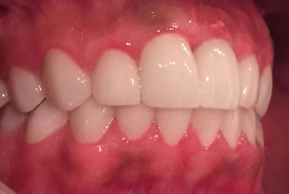 Zirconia Crowns Zirconia Crowns