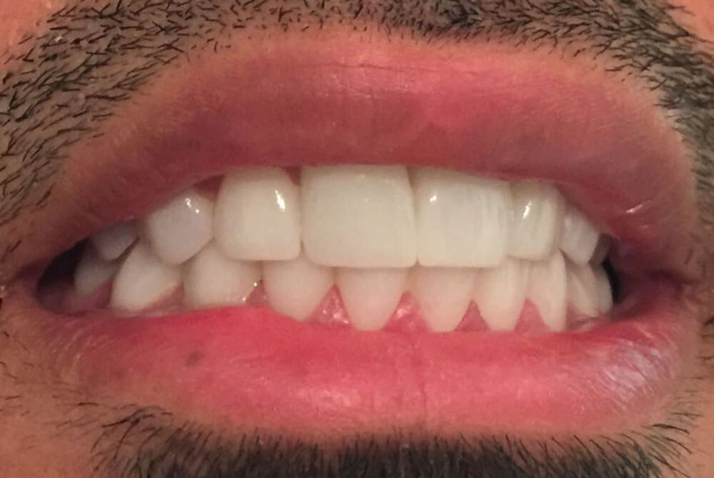Zirconia Crowns Zirconia Crowns
